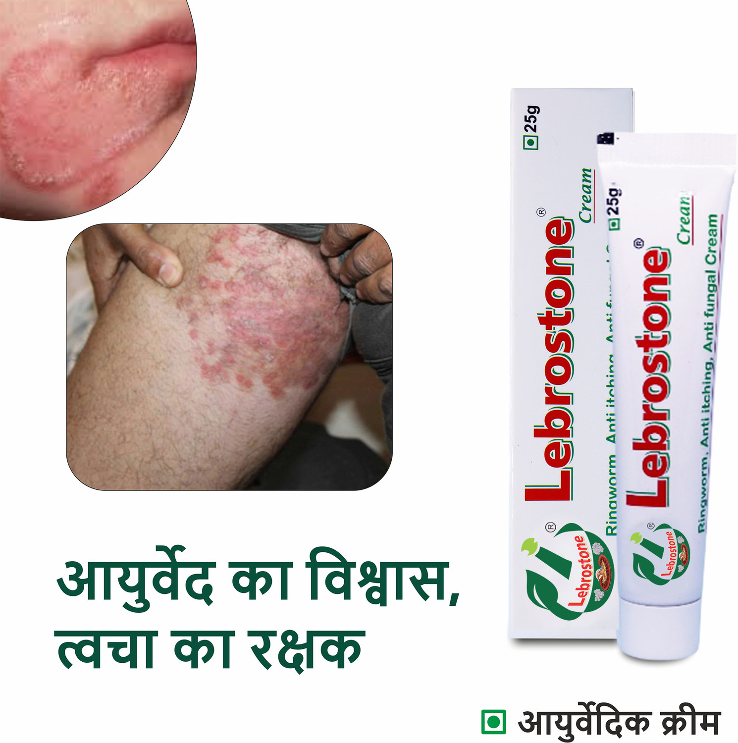Image of Lebrostone Ayurvedic Skin Care Treatment Cream 25g - For Ringworm, Itching & Fungal Infections (Pack of 6)