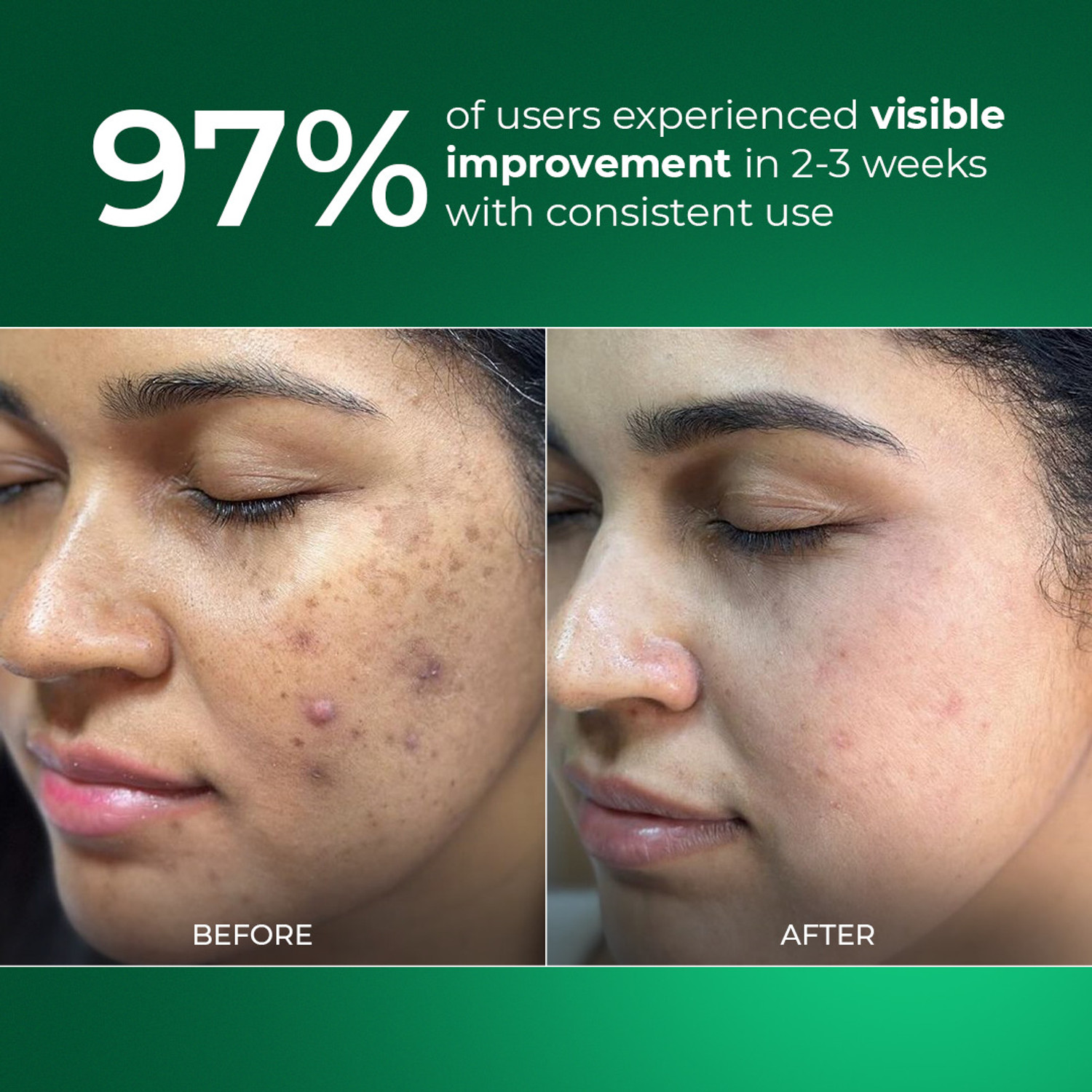 Image of Aqueria 3% Niacinamide Oil Control French Face Serum Reduces Acne & Dark Spots For Oily & Combination Skin