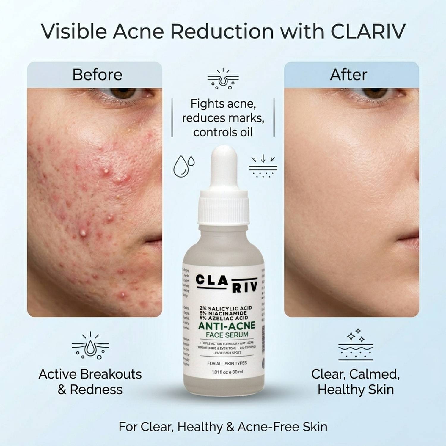 CLARIV Anti-Acne Serum with Niacinamide, Salicylic & Azelaic Acid - Image 5