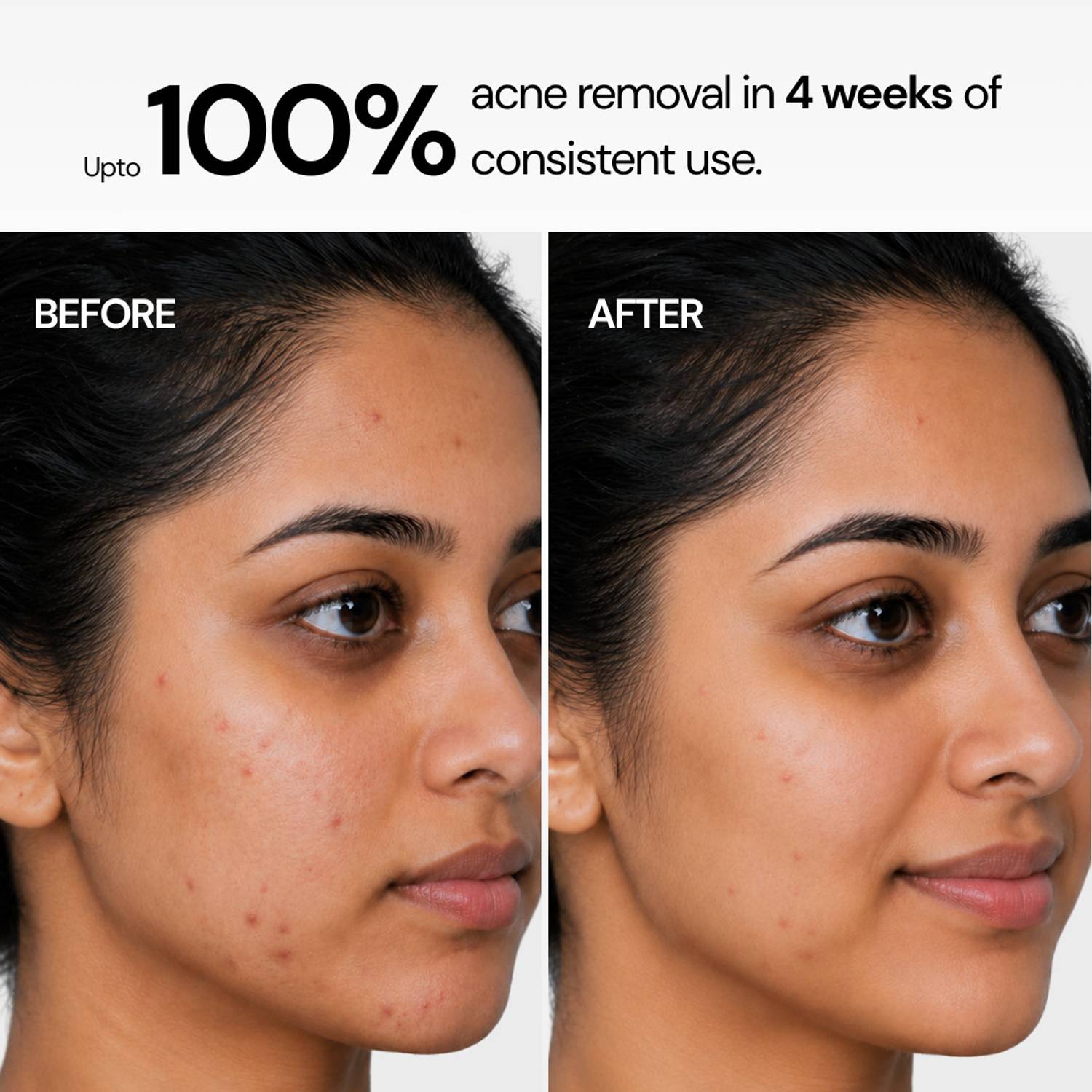 ClarityLabs Anti Acne Oil Control Soap | For Pimples & Dark Spot ... more