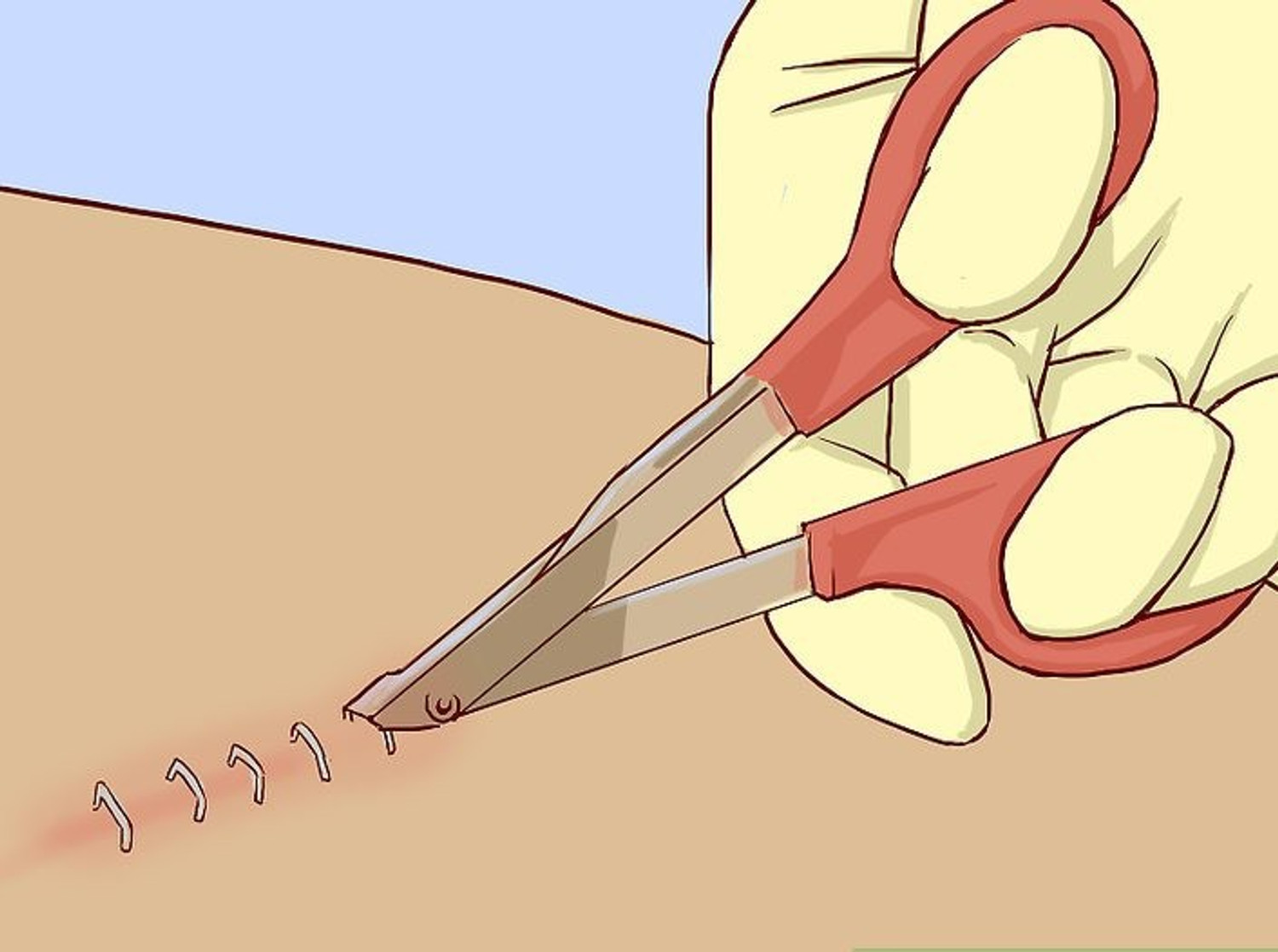 Image of V SURZ SKIN STAPLER 35 MANNUAL SKIN STAPLER AND STAPLE REMOVAL