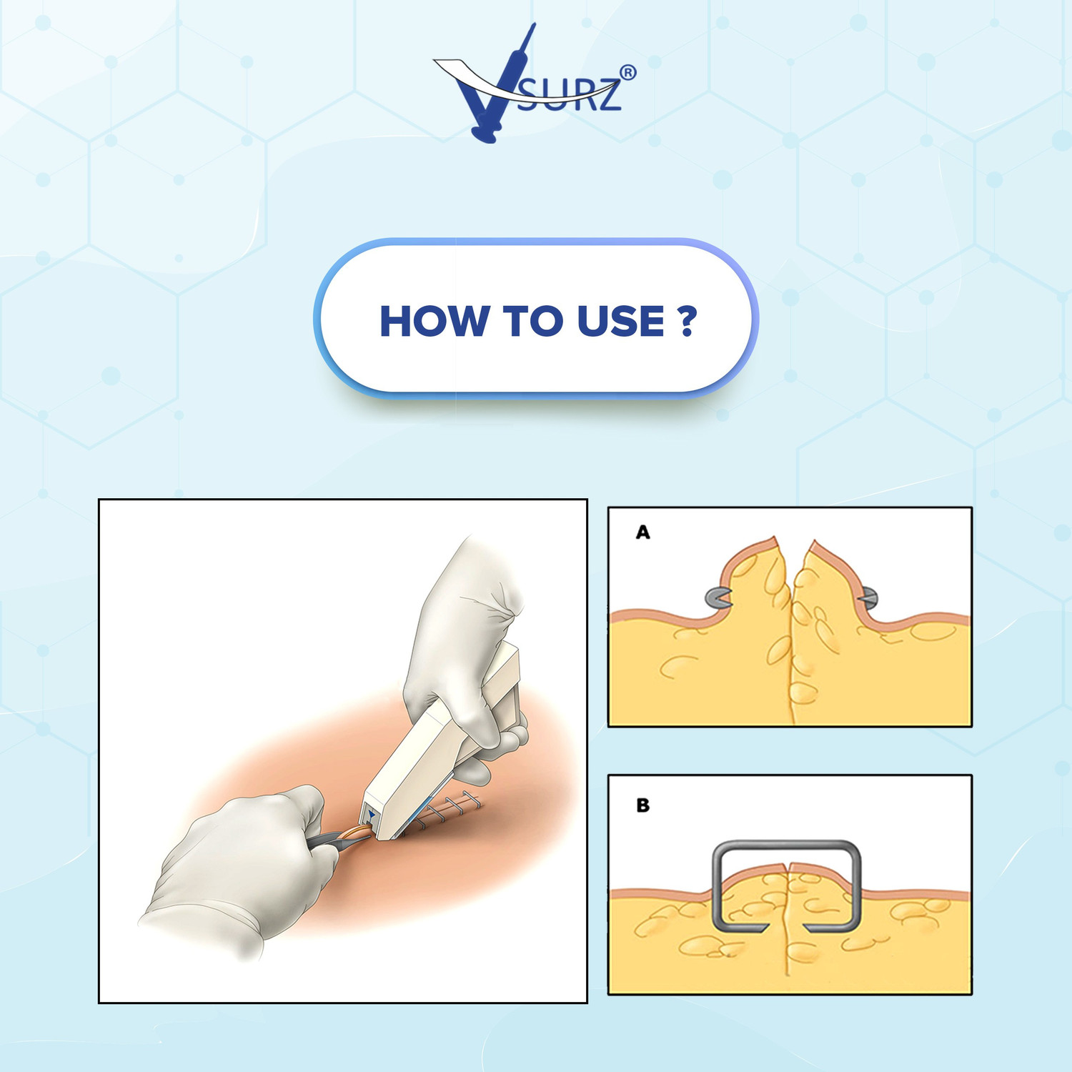Image of V SURZ SKIN STAPLER 35 MANNUAL SKIN STAPLER AND STAPLE REMOVAL