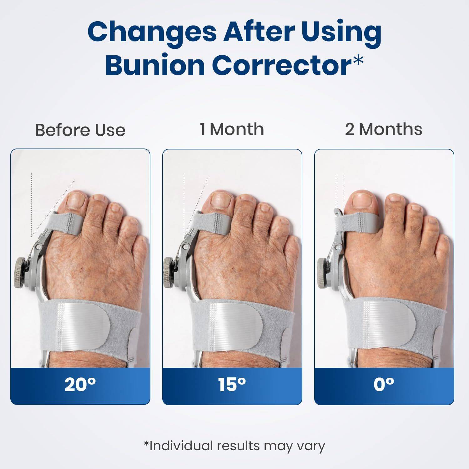 AGEasy Orthopedic Toe Straightener, Adjustable Bunion Corrector - Image 5