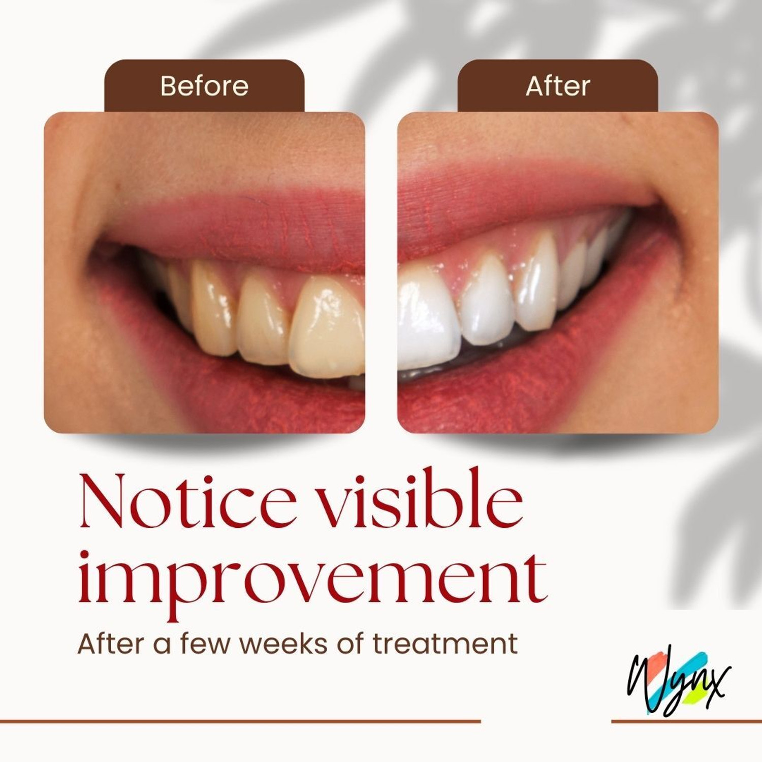 Image of wynx SP4 Teeth Whitening Toothpaste 3pc - Enamel Protection + Minty Fresh Toothpaste